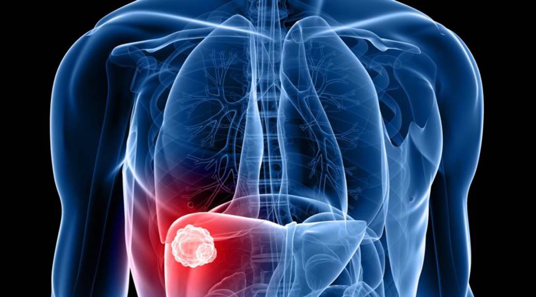 Cirurgia de Fígado