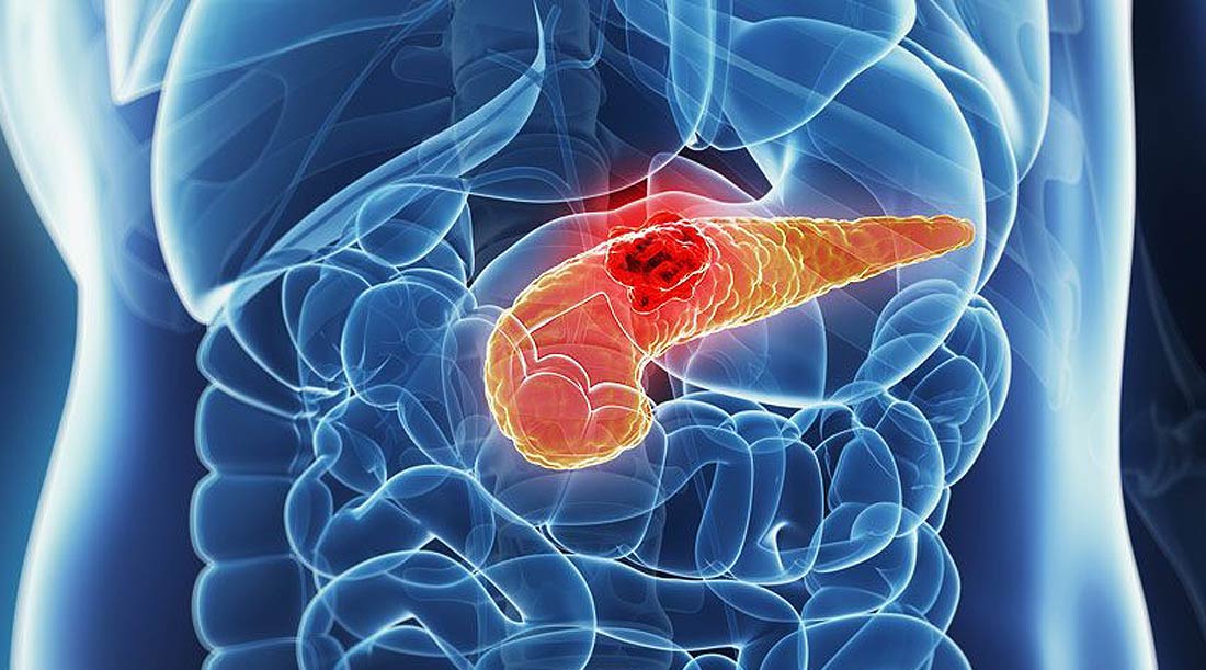 Cirurgia de Pâncreas